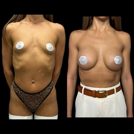 Маммопластика Краснодар