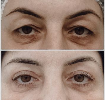 Круговая блефаропластика