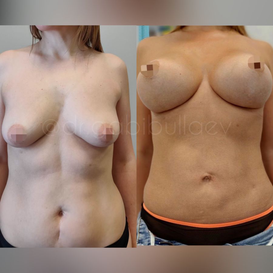 Подтяжка груди на имплантах