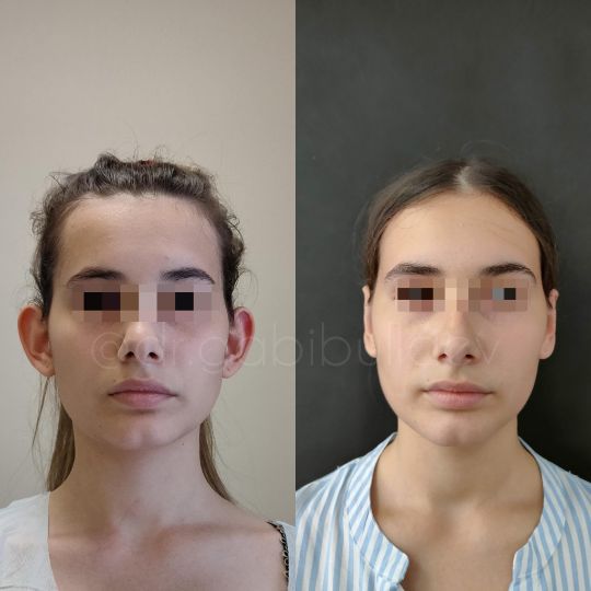 Отопластика