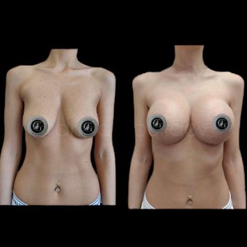 Маммопластика