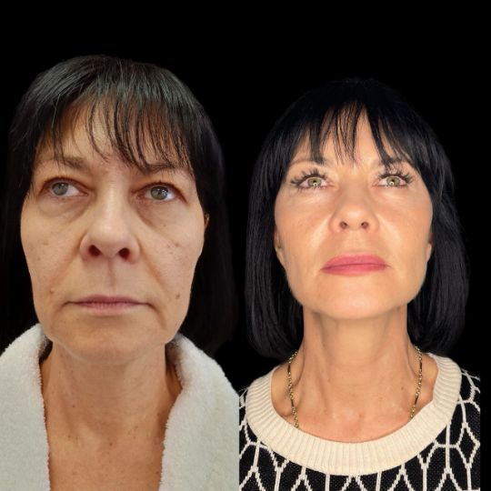 Подтяжка лица smas лифтинг