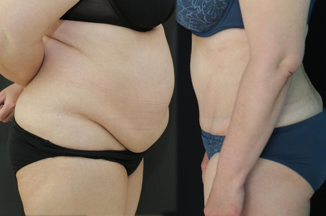 Абдоминопластика Краснодар