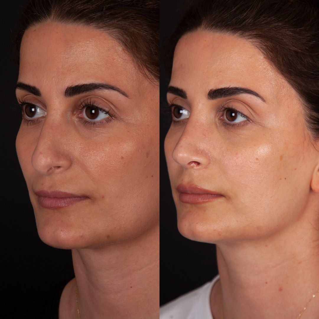 Септопластика Краснодар