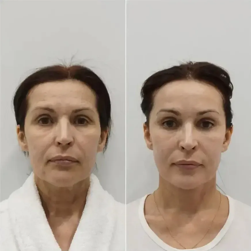 Пример работы доктора Мельникова Дмитрия Александровича в области ринопластики.
