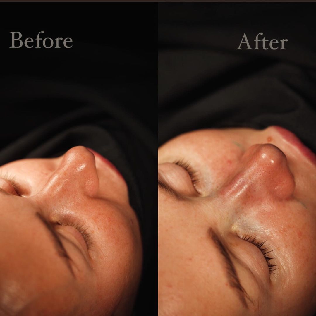 Ринопластика Краснодар