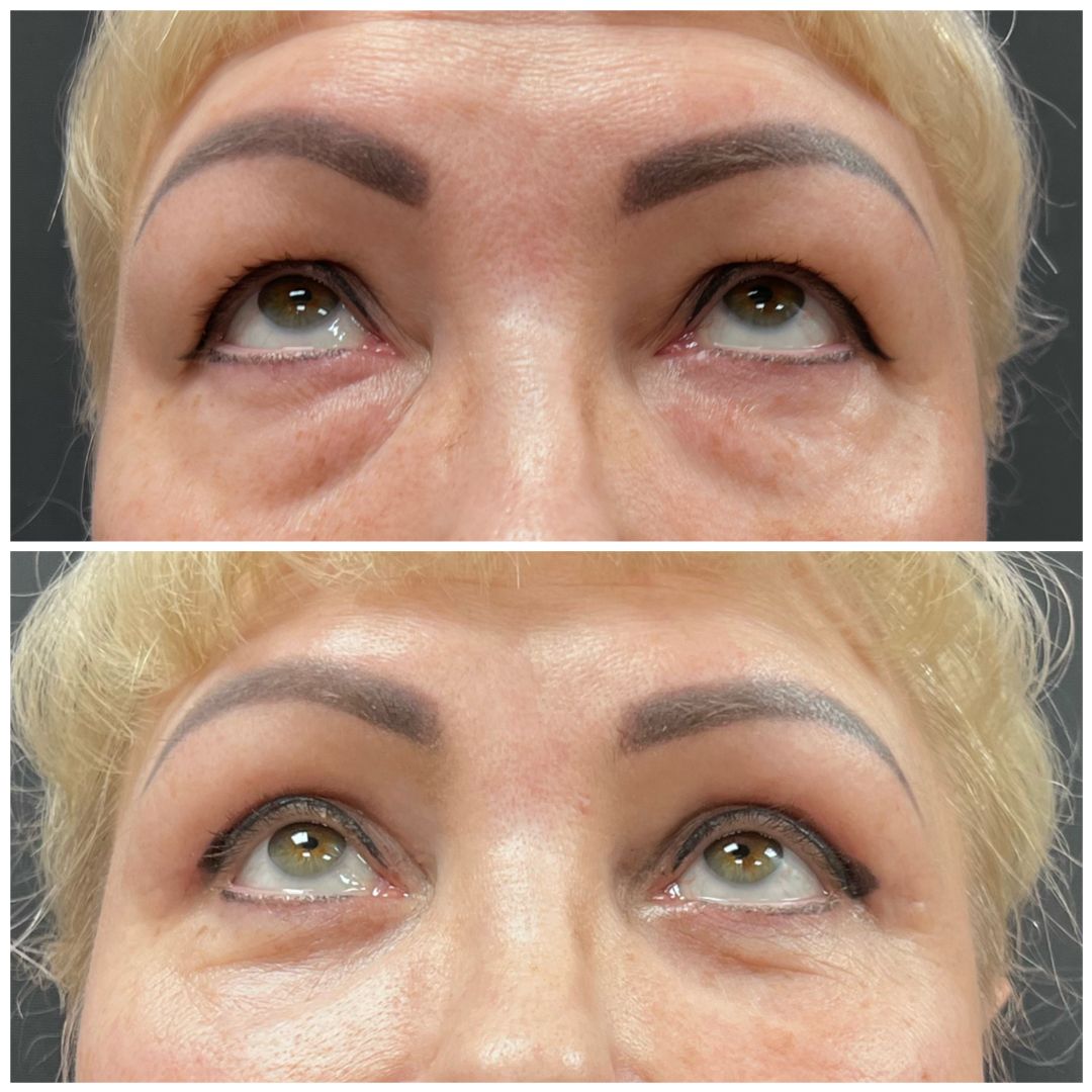 Круговая блефаропластика