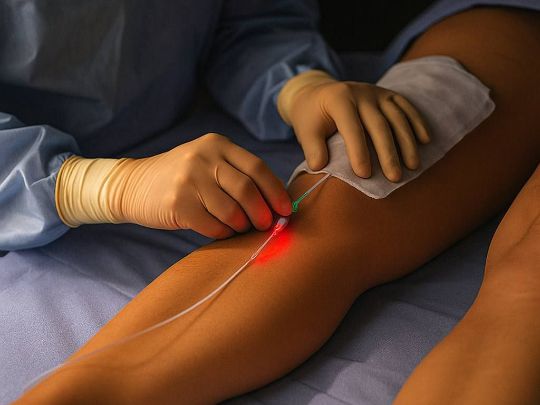 Лазерное лечение варикоза