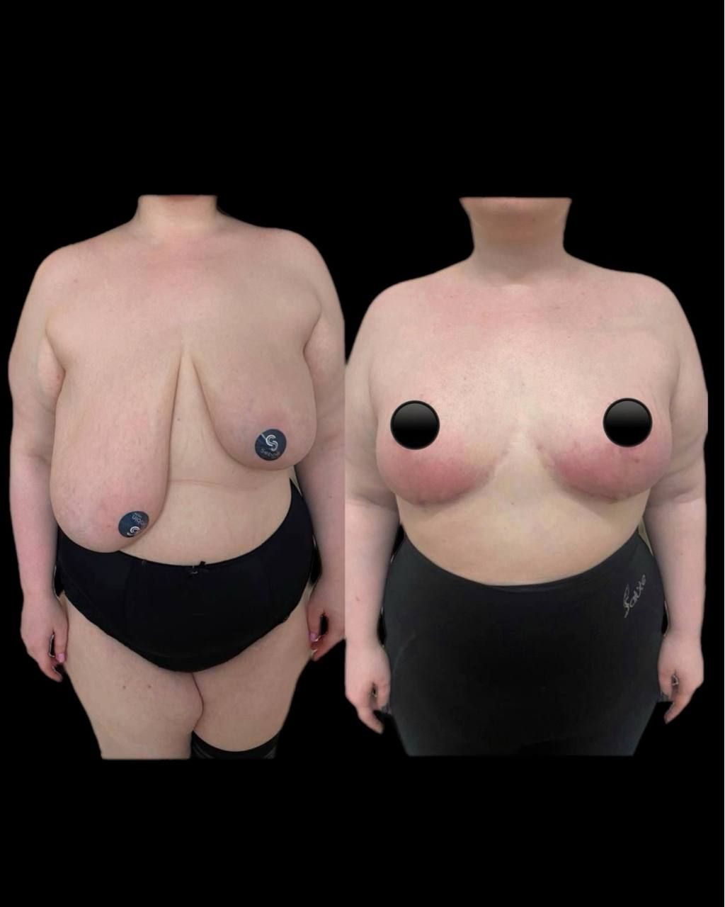 Симметризация груди