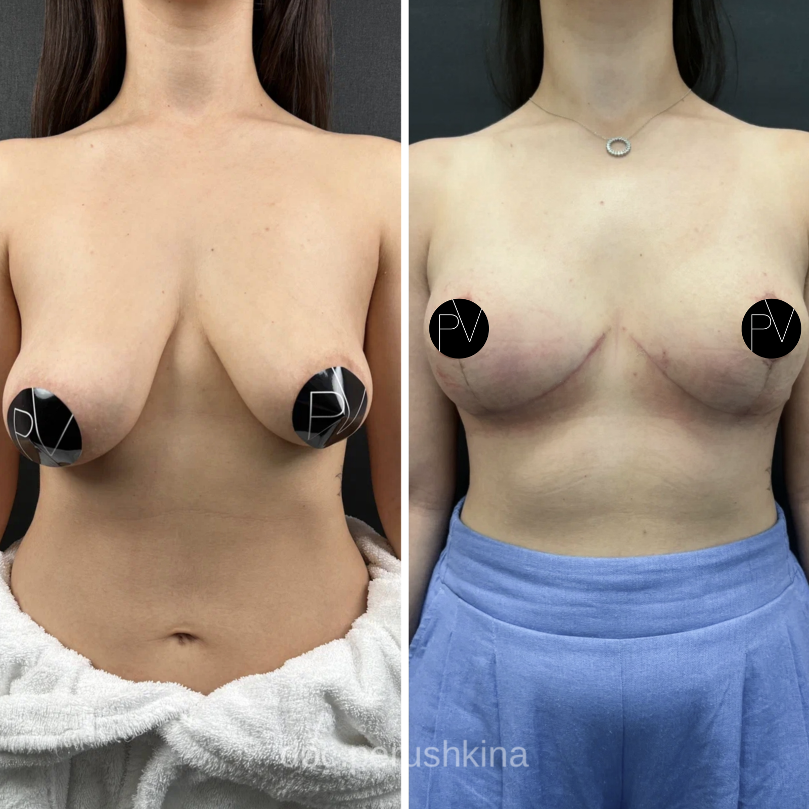 Якорная подтяжка груди