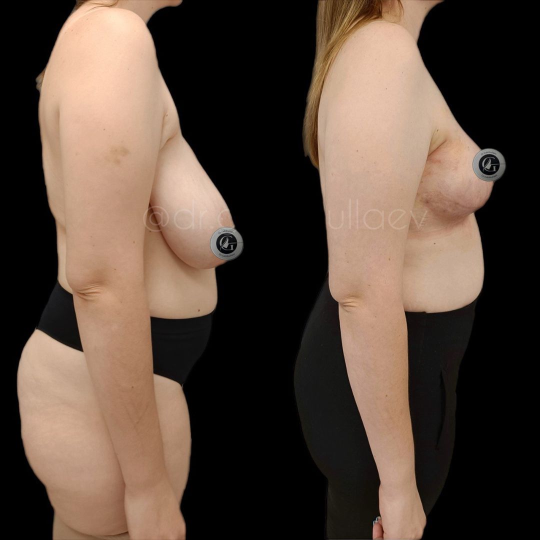 Уменьшение груди