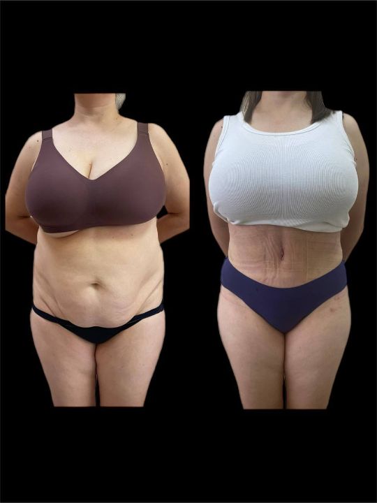 Липоабдминопластика Краснодар