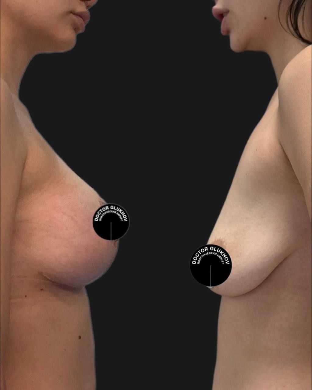 Подтяжка груди с увеличением
