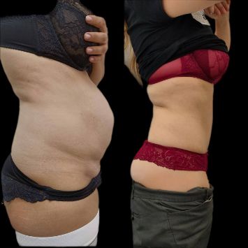 Липоабдоминопластика