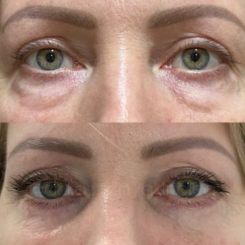 Нижняя блефаропластика