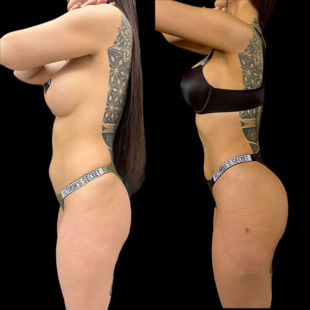 Липофилинг ягодиц