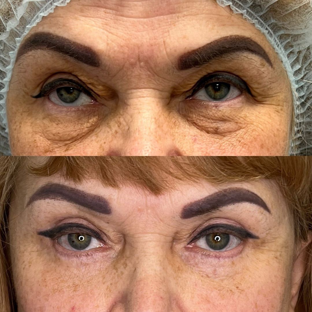 Круговая блефаропластика