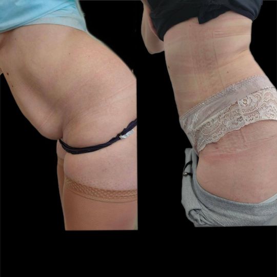Абдоминопластика Краснодар
