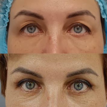 Блефаропластика Краснодар