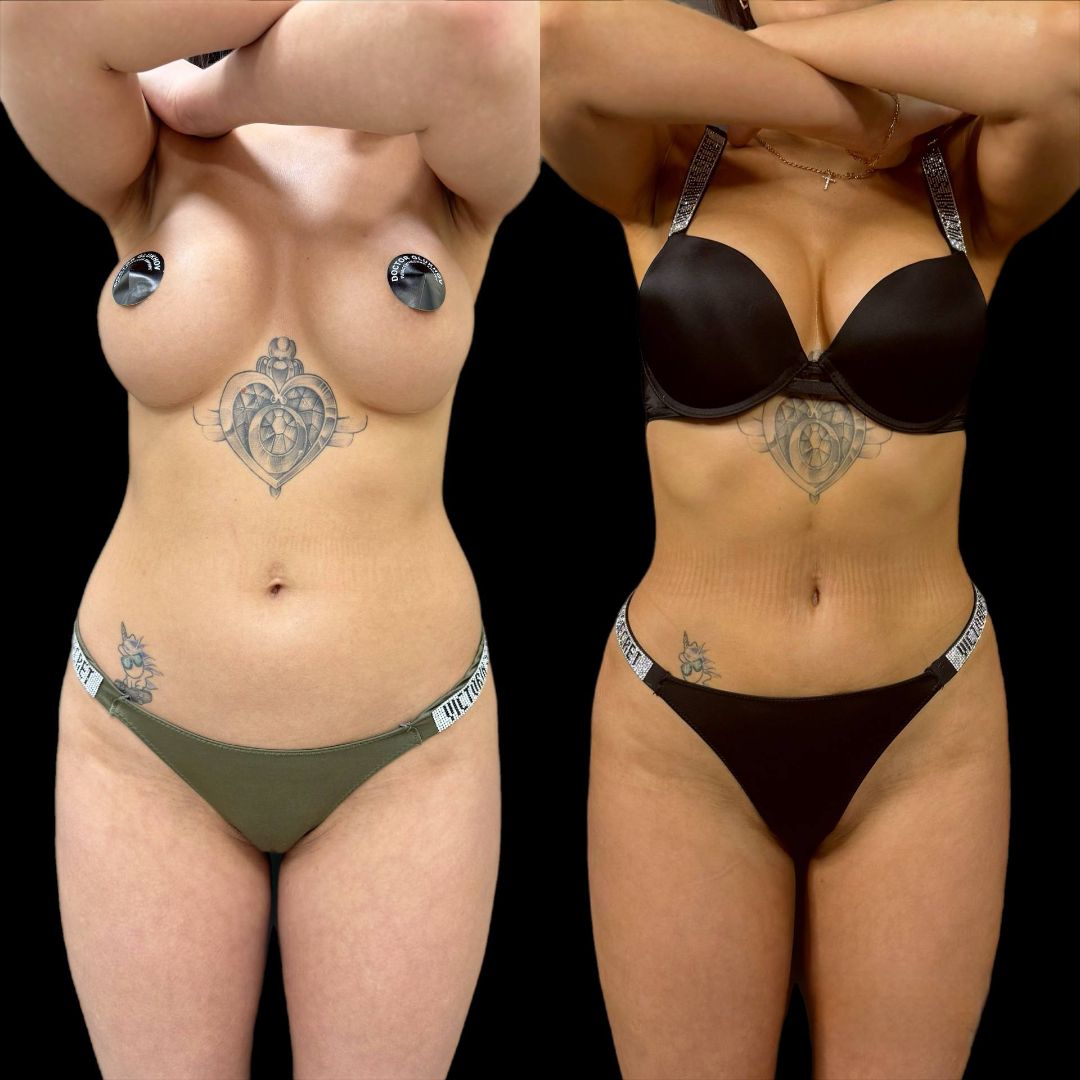 Липосакция Краснодар