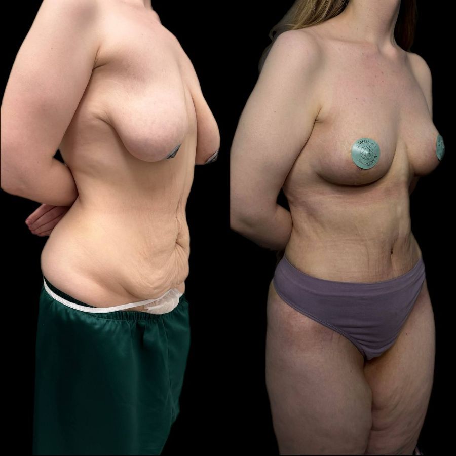 Послеродовое восстановление