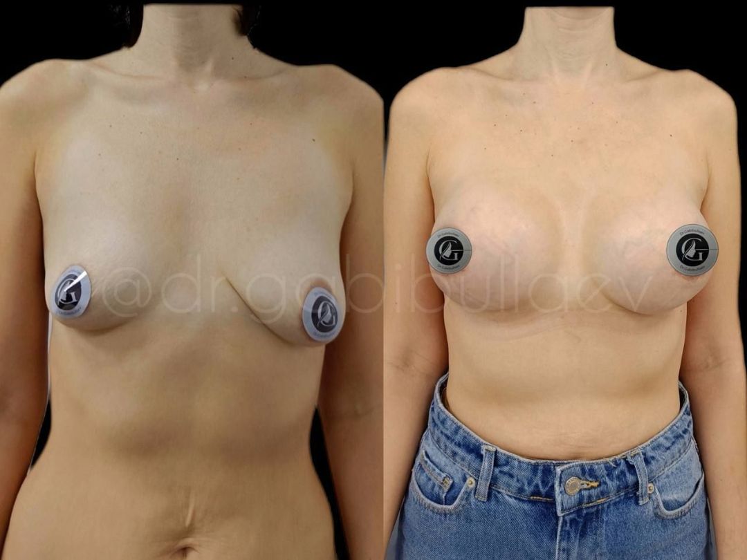 Увеличение груди с подтяжкой