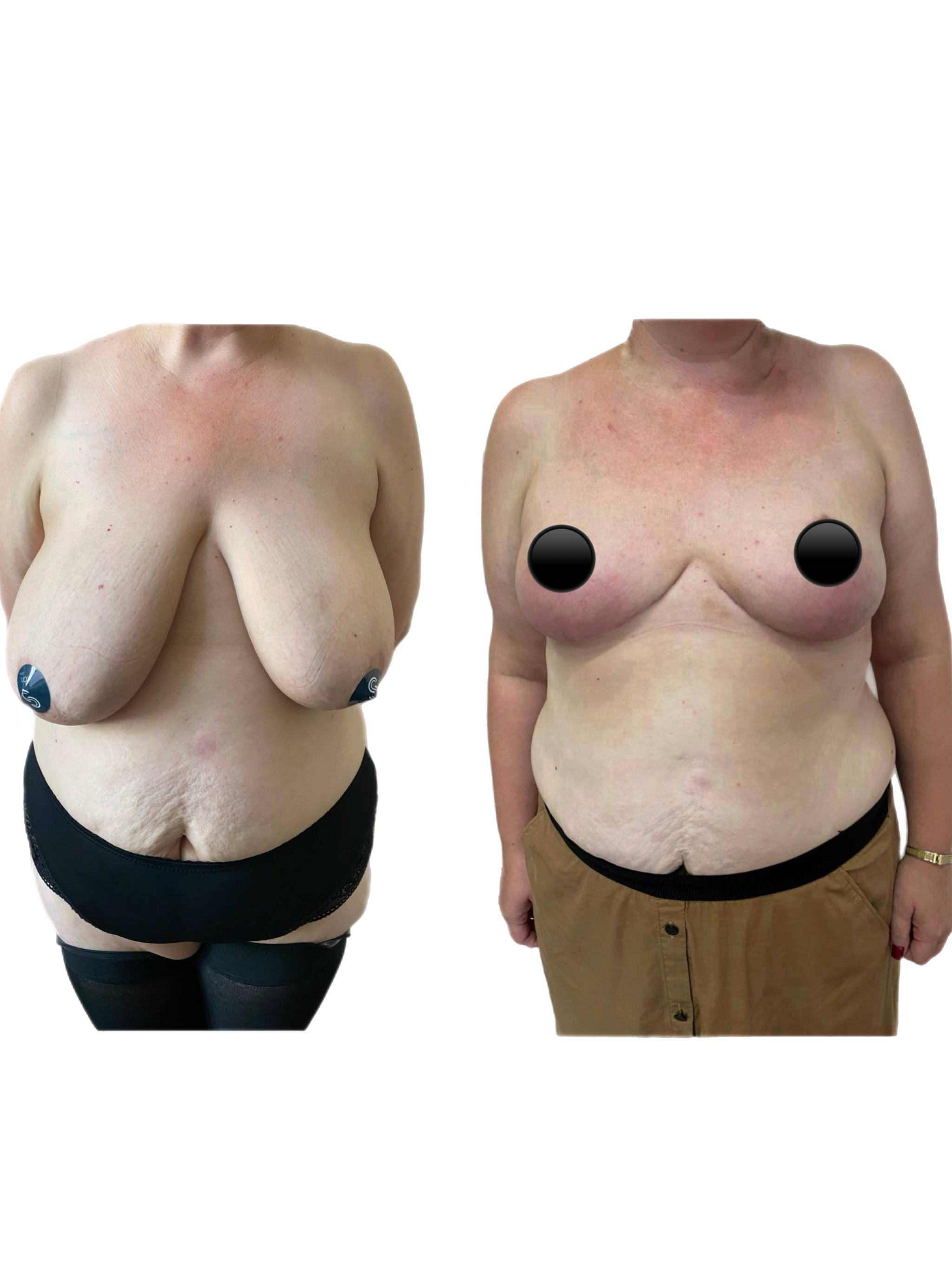 Уменьшение груди