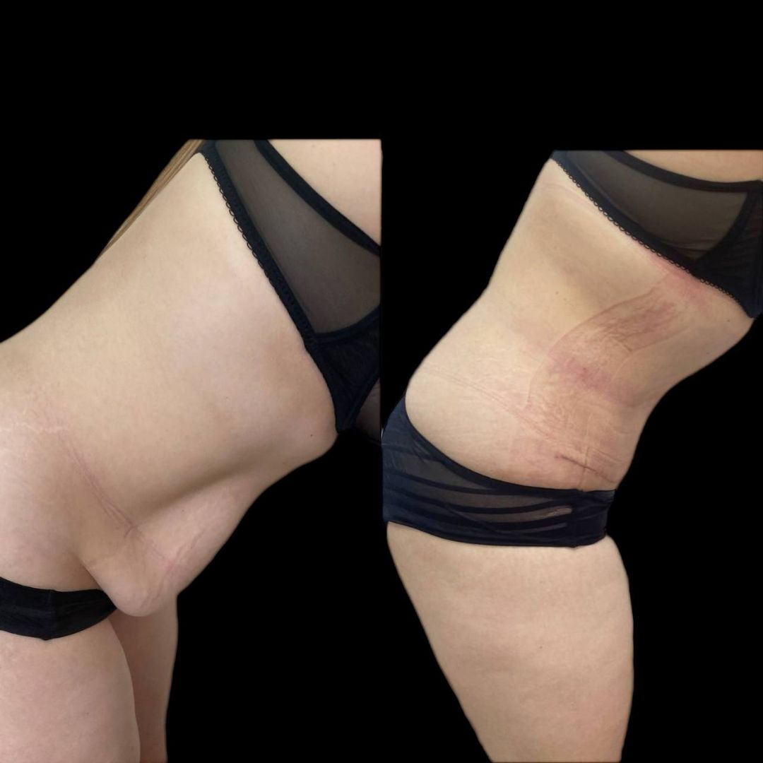 Абдоминопластика Краснодар