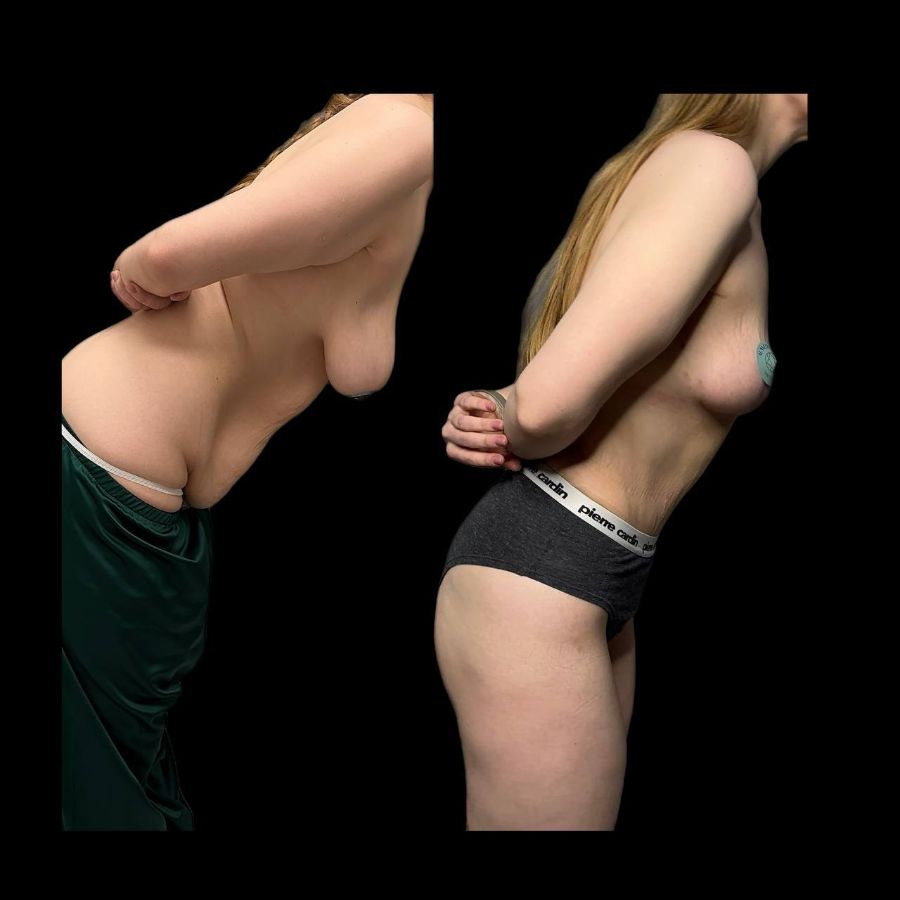 Подтяжка г8руди без имплантов