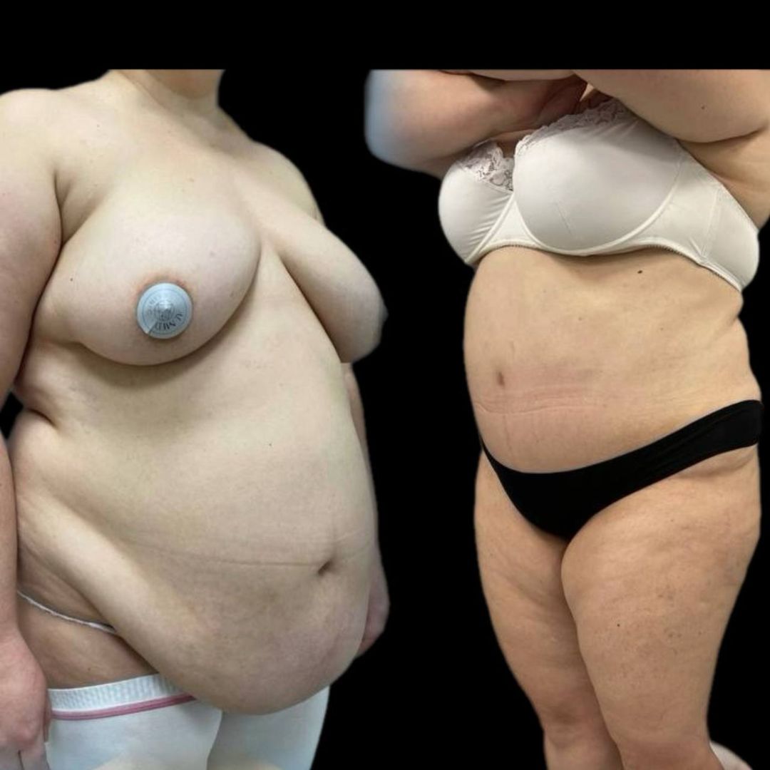 Липосакция в сочетании с абдоминопластикой