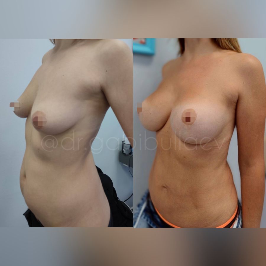 Липосакция живота