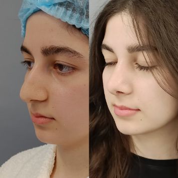 Риносептопластика Краснодар