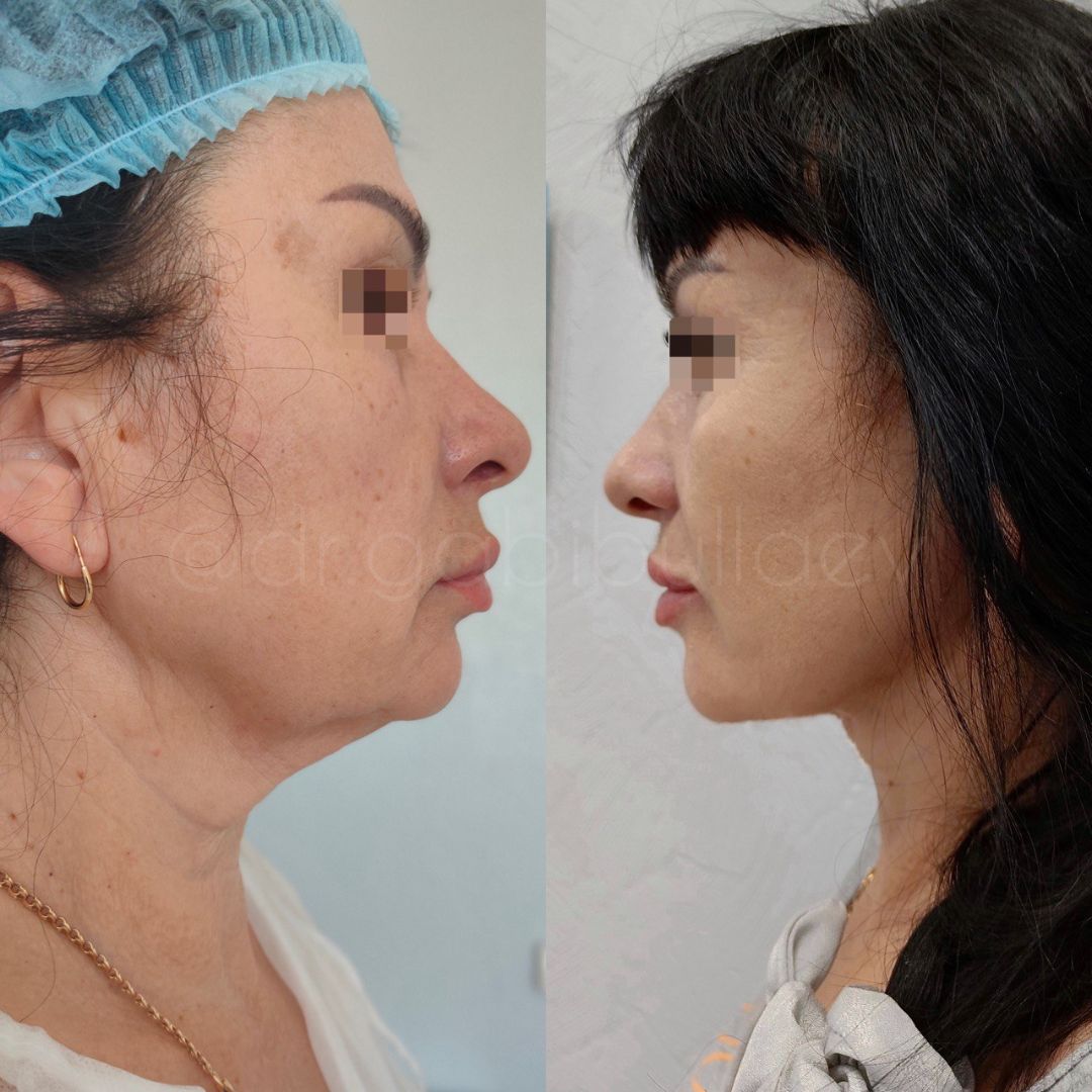 Смас лифтинг