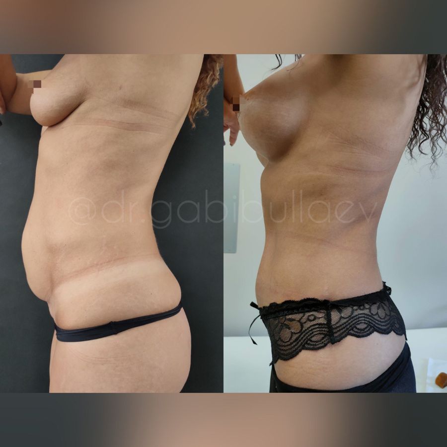 Абдоминопластика увеличение груди