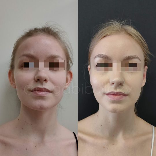 Отопластика