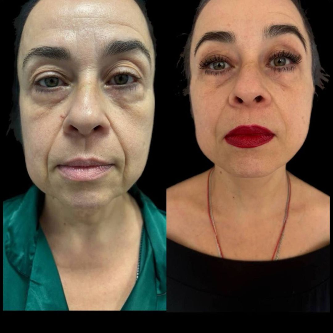 Фейслифтинг Краснодар