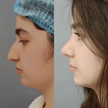 Ринопластика Краснодар