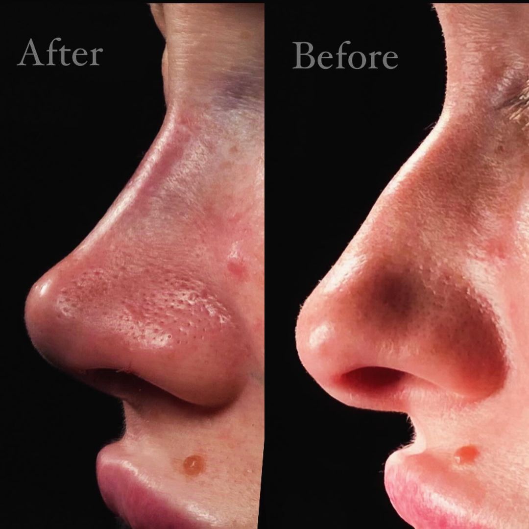 Ринопластика первичная