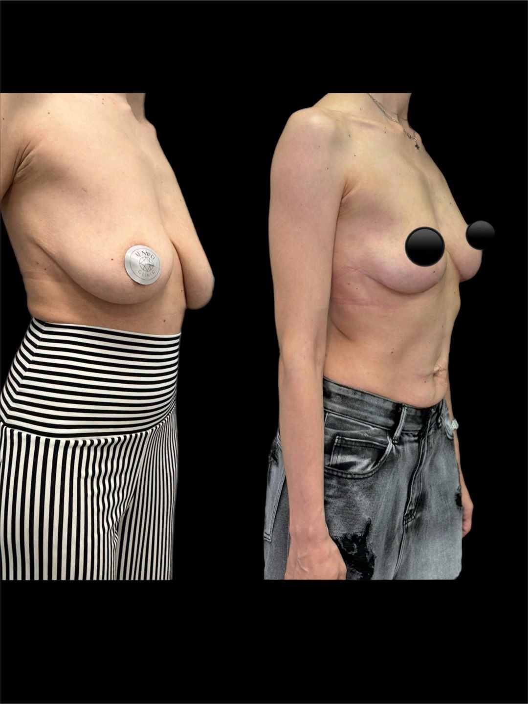 Подтяжка груди Краснодар