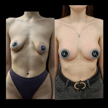 Увеличение груди на имплантах