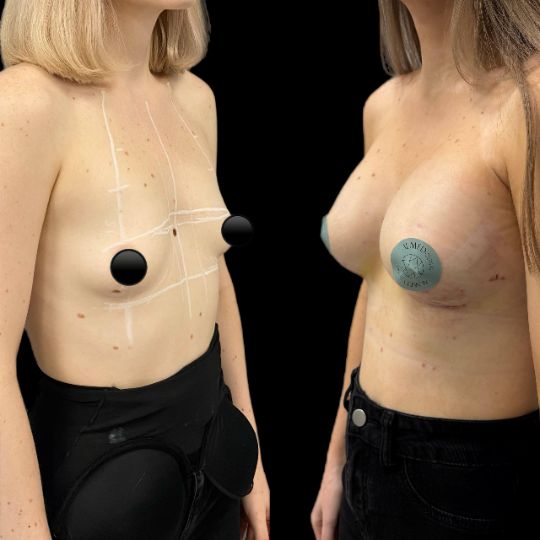 Увеличение груди Краснодар