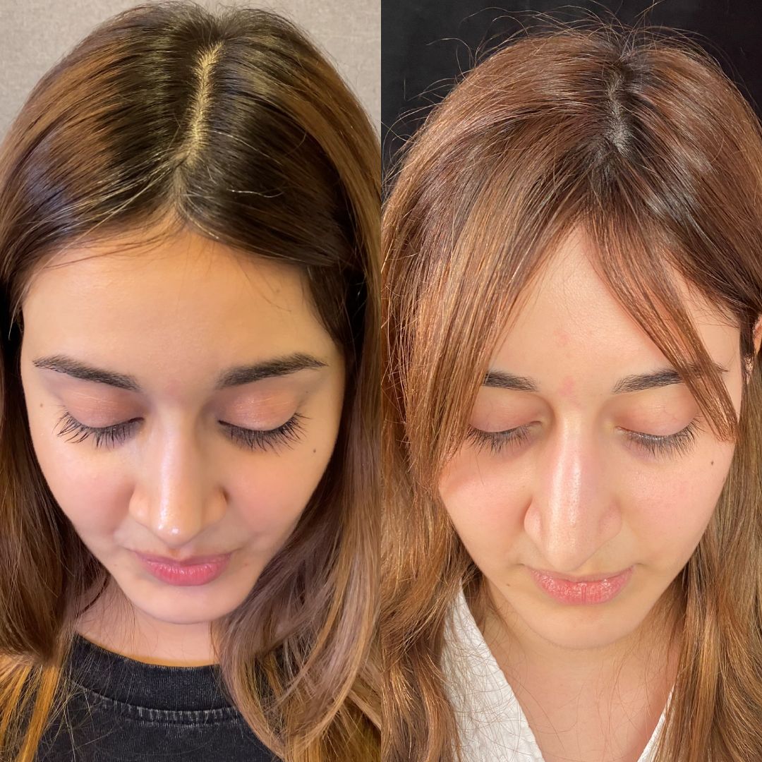 Риносептопластика