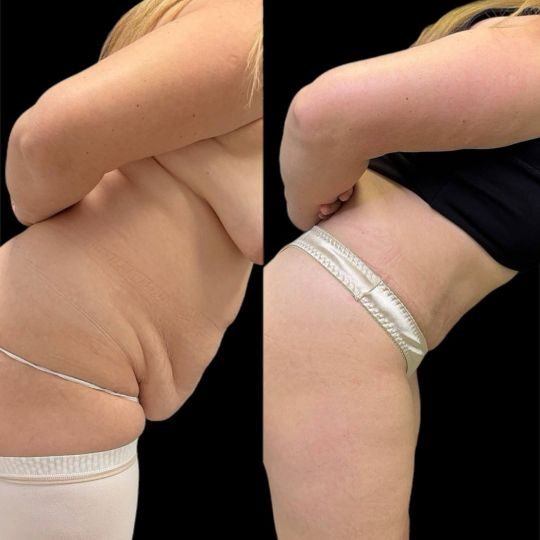 Абдоминопластика Краснодар