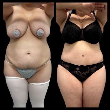 Липоабдоминопластика Краснодар