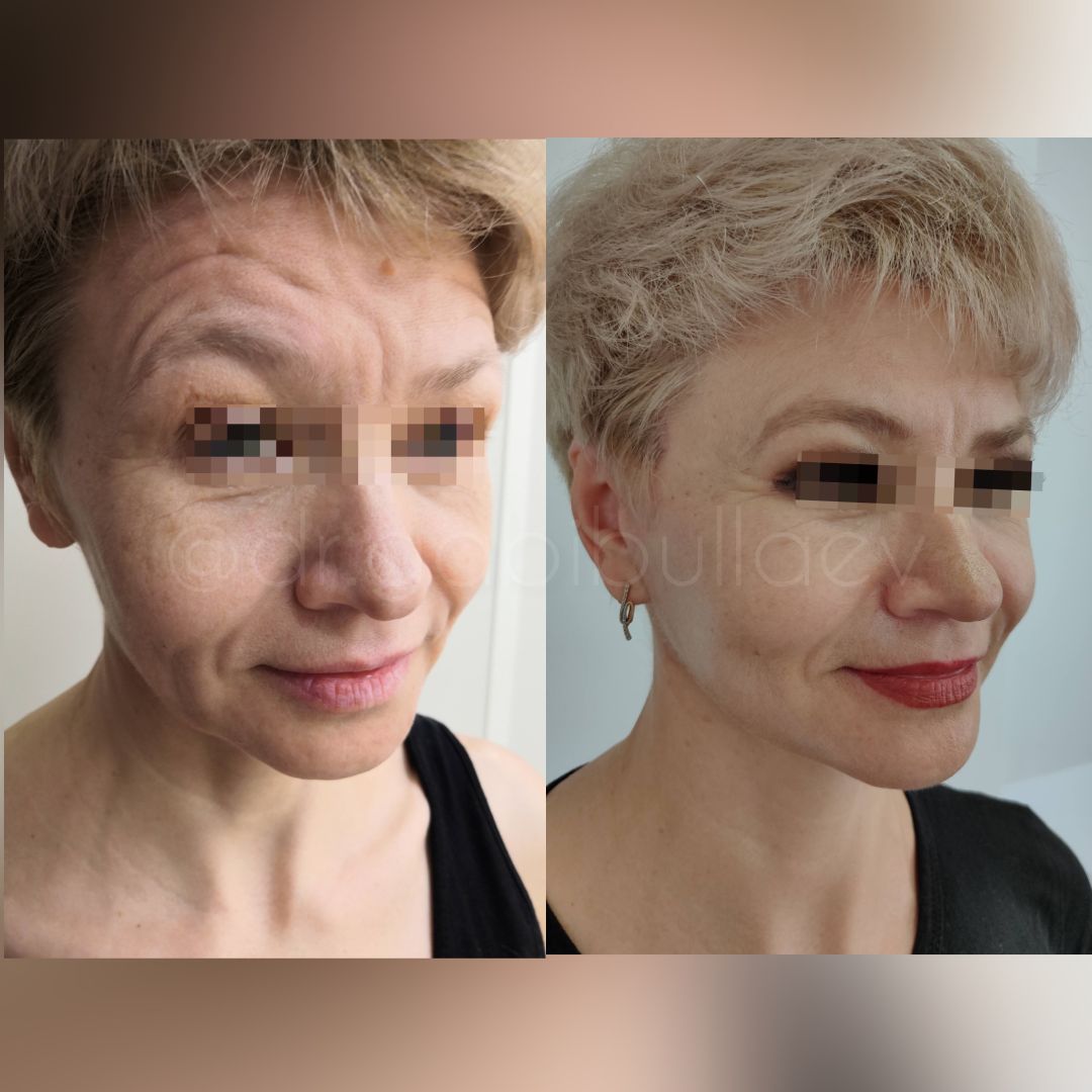 Кругговая подтяжка лица