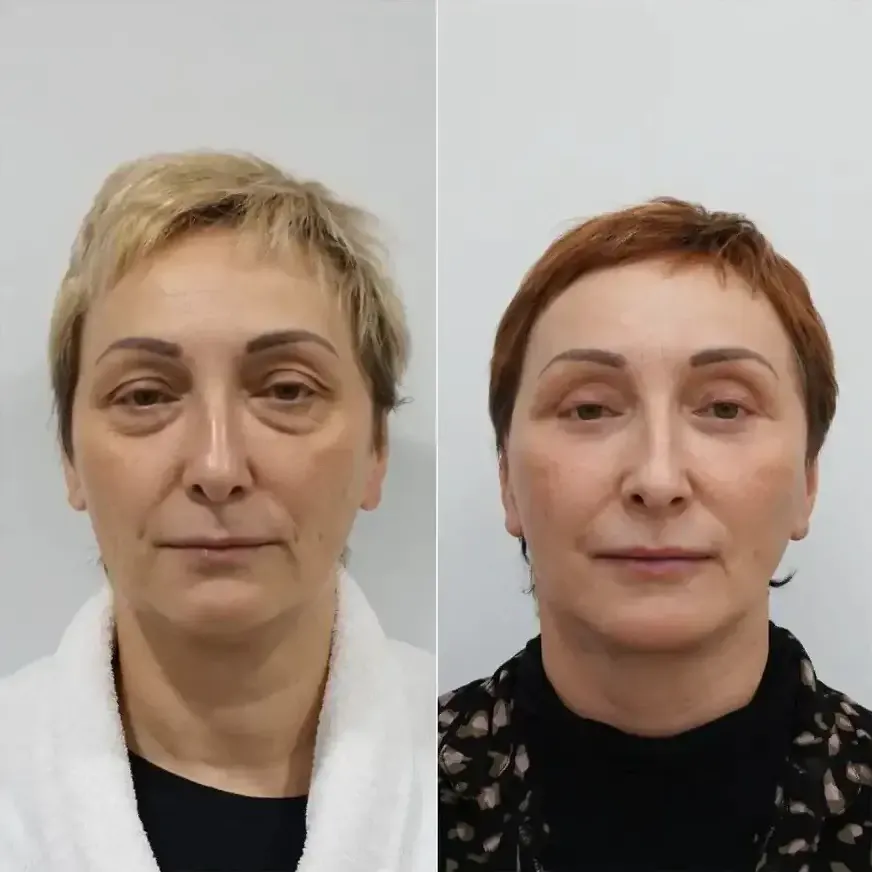 Пример работы доктора Мельникова Дмитрия Александровича в области ринопластики.