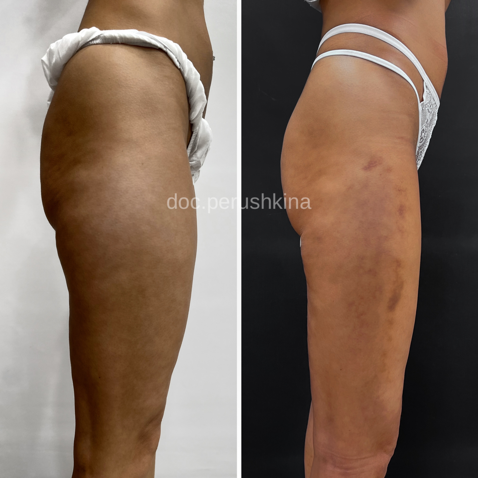 Липосакция