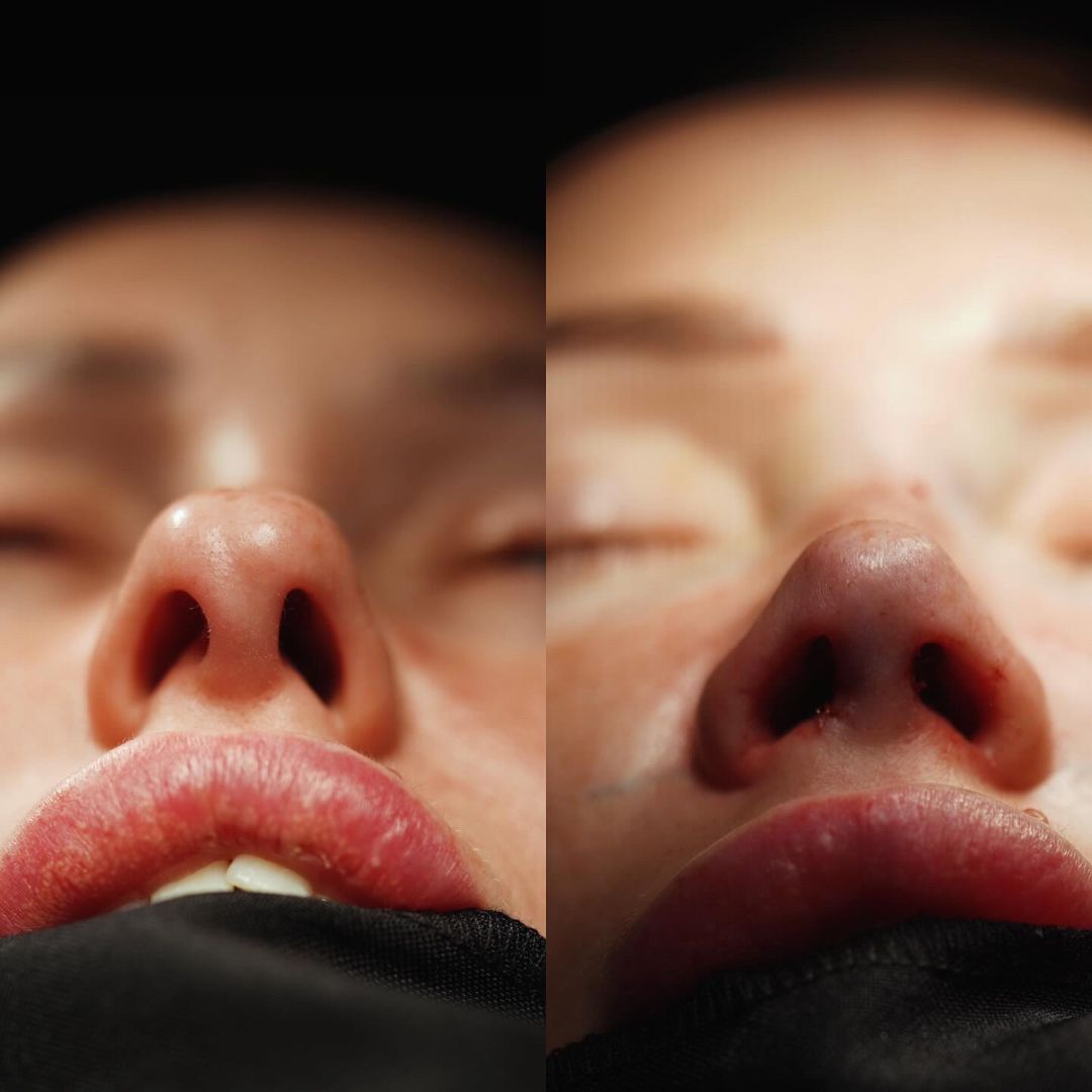 Пластика носа