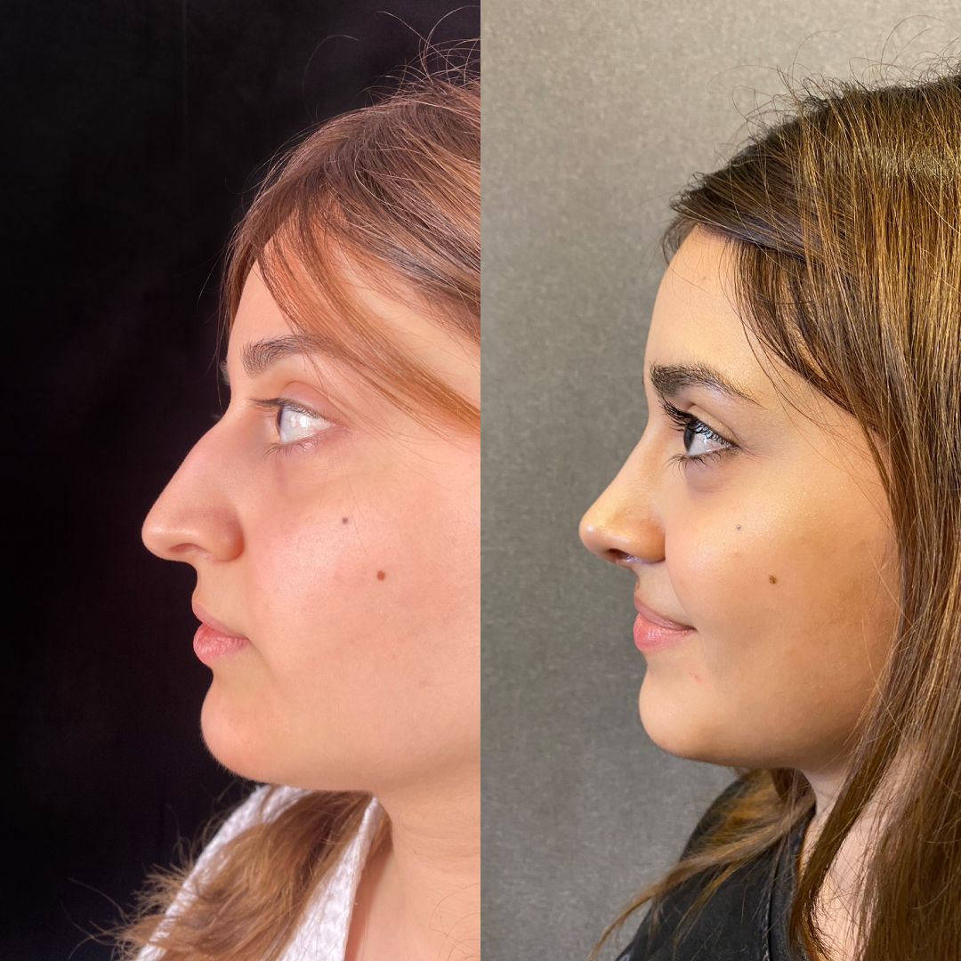 Ринопластика Краснодар