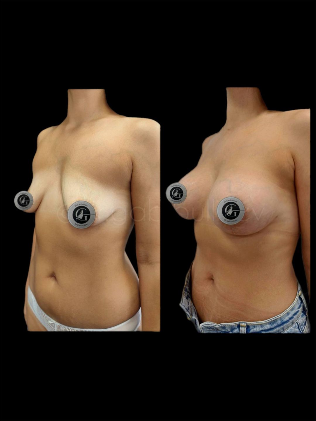 Увеличение груди Краснодар